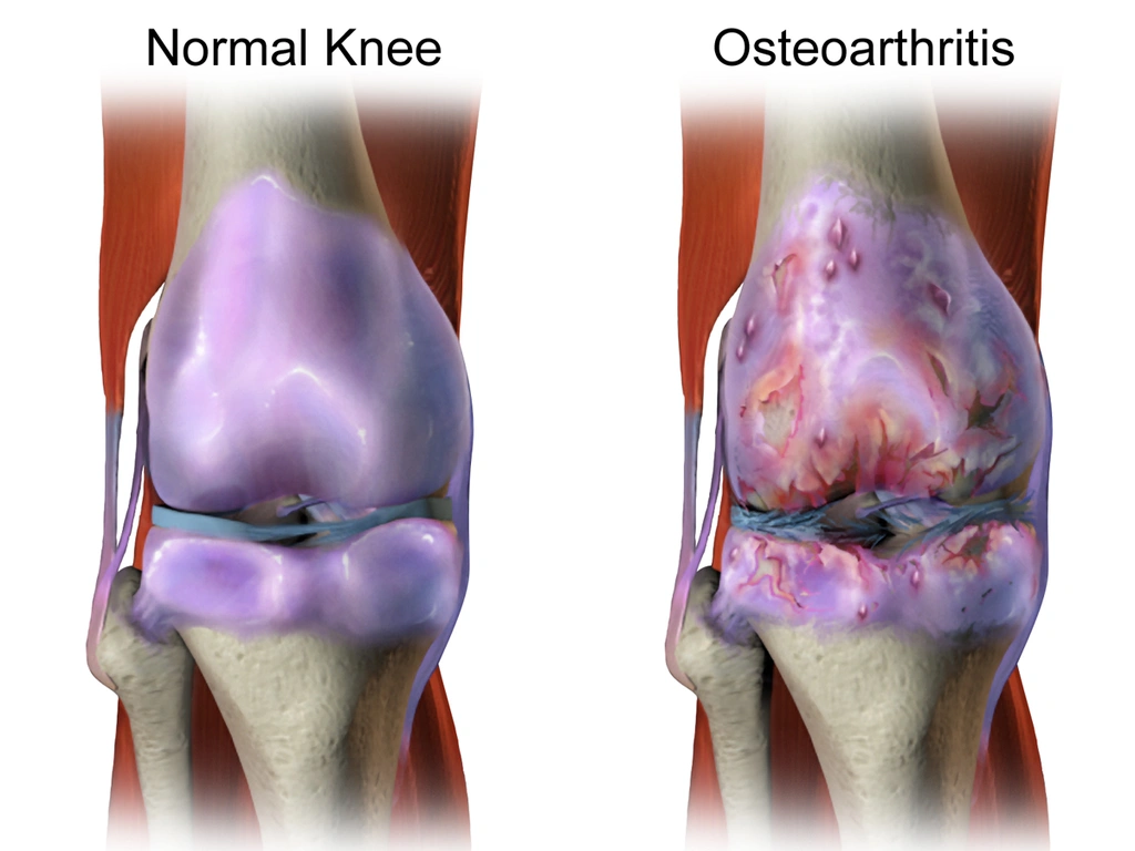 Arthritis Pain Types and Best Treatment in Pune 1 Osteoarthritis treatment by pune Arthritis Pain Types and Best Treatment in Pune