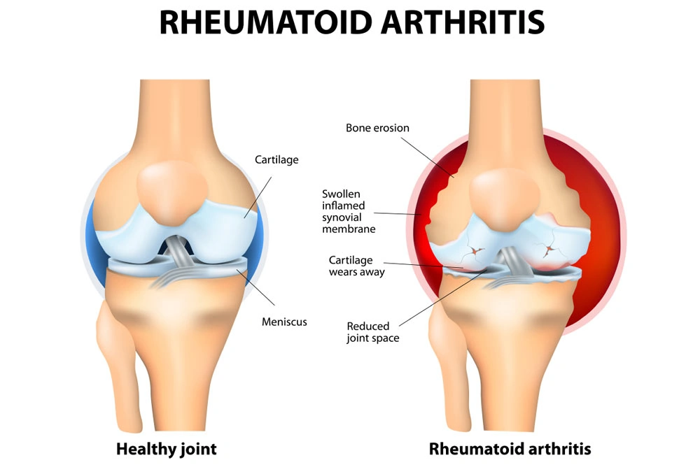Arthritis Pain Types and Best Treatment in Pune 2 Rheumatoid arthritis treatment by Healyos Arthritis Pain Types and Best Treatment in Pune