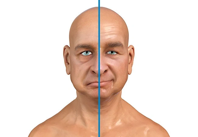 Bells palsy and its treatment Symptoms of Bells palsy and its treatment in Pune