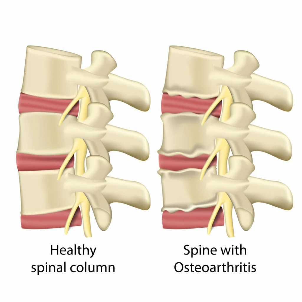 Understanding Upper Back Pain: Causes, Symptoms, and Solutions 5 GetPaidStock.com 67da9c55927d9 Understanding Upper Back Pain: Causes, Symptoms, and Solutions