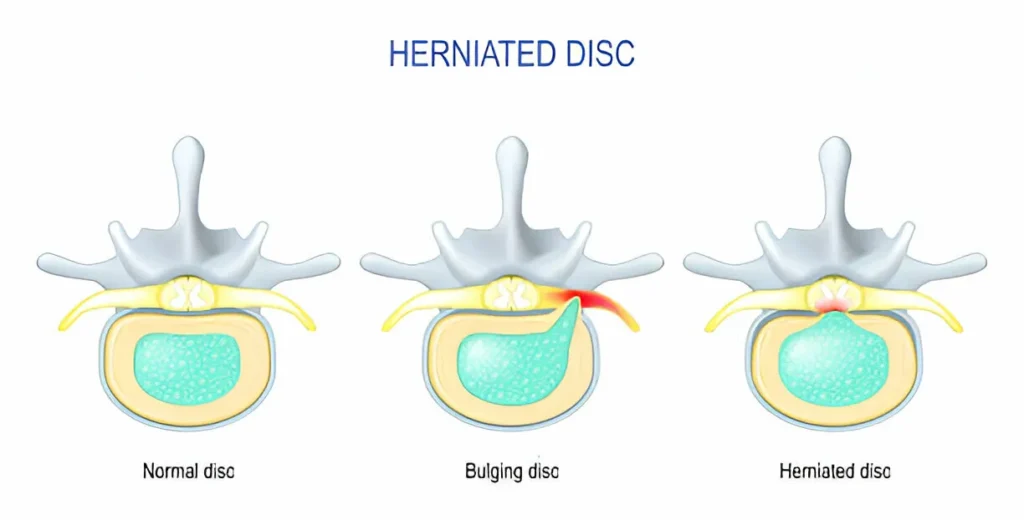 Everything You Need to Know About Lower Back Pain 3 GetPaidStock.com 67dbc61c80361 2 Everything You Need to Know About Lower Back Pain