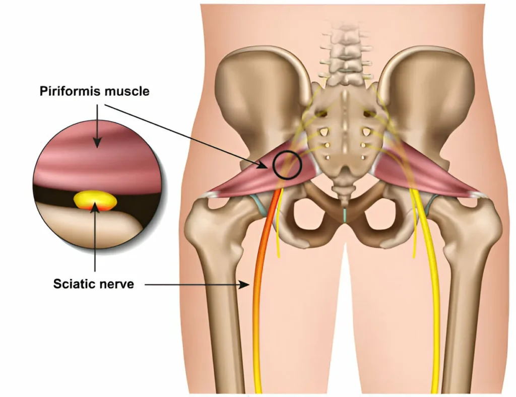 GetPaidStock.com 67dbe5df0d737 What is Sciatica? Causes, Treatments, and Pain Relief Tips