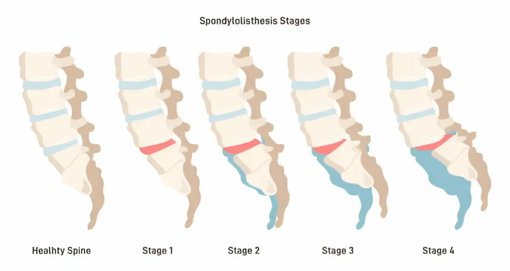GetPaidStock.com 67dbe676081d1 117545108d What is Sciatica? Causes, Treatments, and Pain Relief Tips