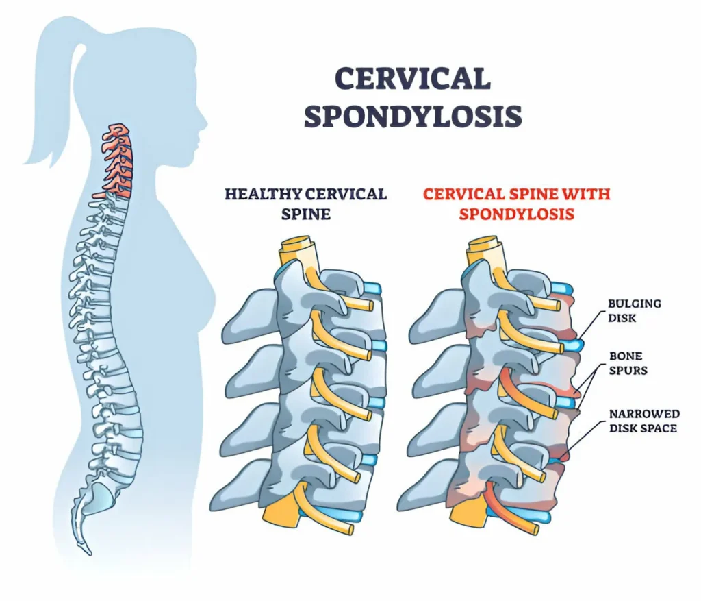 GetPaidStock.com 68089e4ec59f8 Understanding the Difference Between Spondylosis and Spondylitis