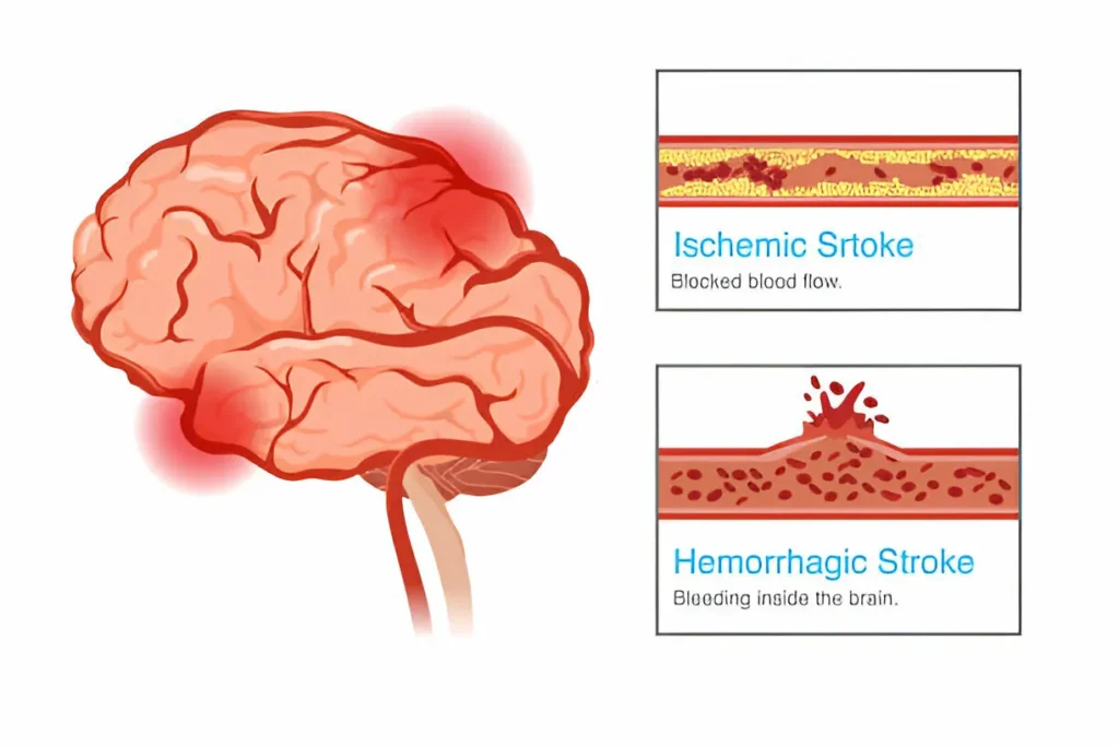 GetPaidStock.com 6810e2dd0b784 Brain Stroke Recovery Time: How Long Does It Take?